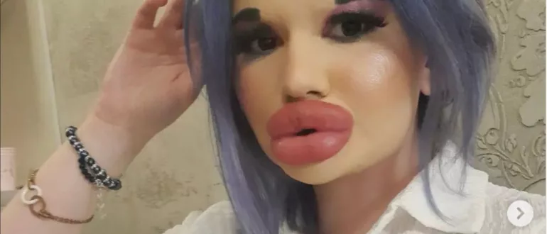 Dit is Andrea, de 'Balkan barbie' die voor 90% uit plastiek bestaat: "Ik  ben knapper met mijn grote lippen" (foto's) | Clint.be